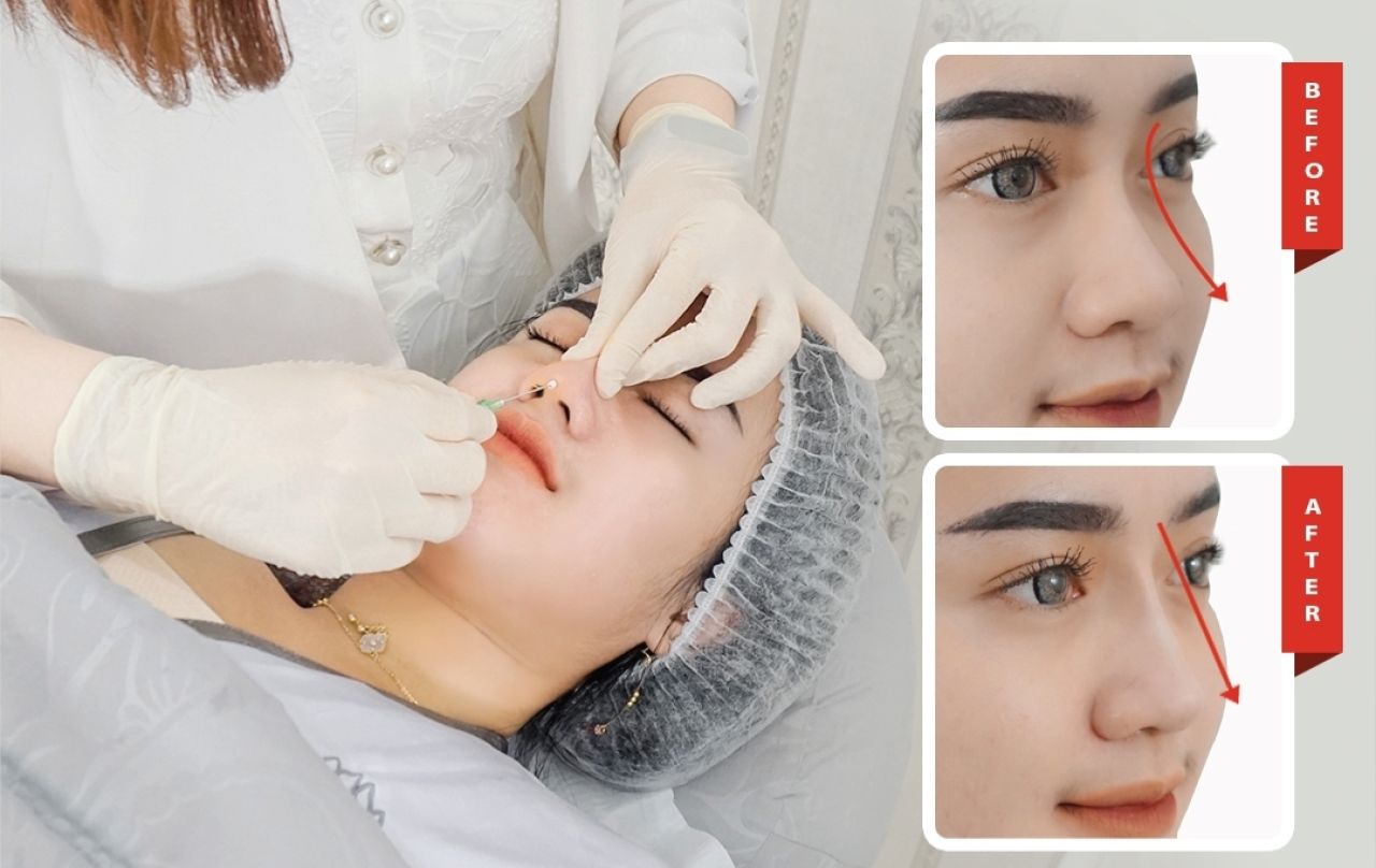 Tips Miliki Hidung Mancung Tanpa Operasi